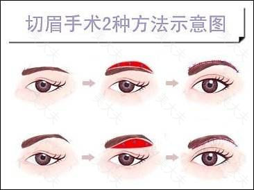 （图一）切眉的两种方法：眉上切口&眉下切口