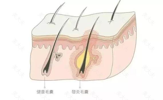 为什么痘痘老是反反复复，还总在同一个位置？