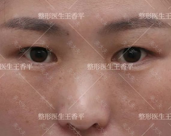 效应术前.jpg