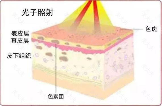 医美界屹立不倒的光子嫩肤，凭什么火了这么多年？