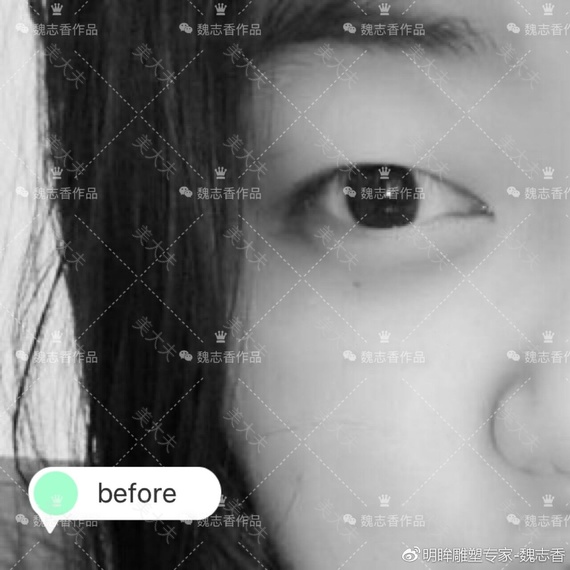 术前 ：单眼皮、肿眼泡 、眼睛无神