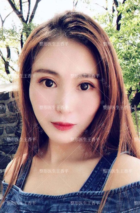 朱颖 重睑内眦 术后1.jpg