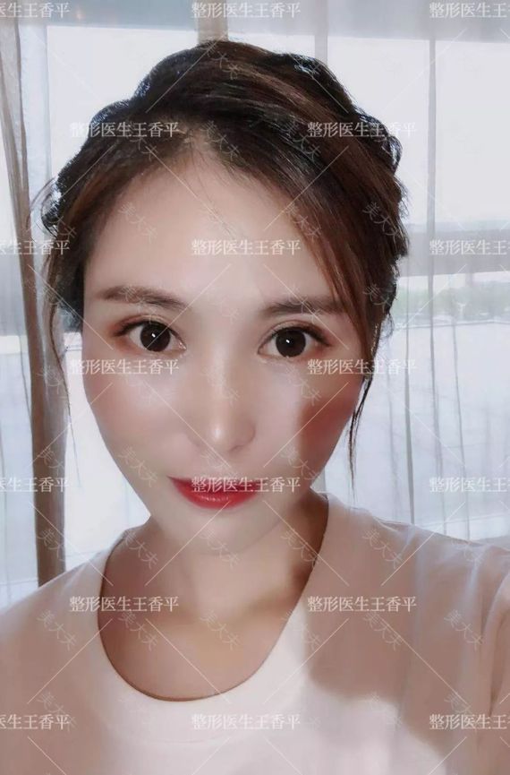 朱颖 术后 重睑 内眦.jpg