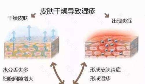 湿疹发作太难受？教你几招缓解