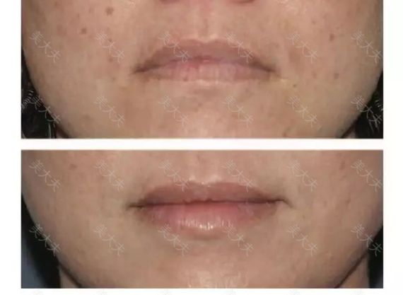 注射肉毒素 上扬你的嘴角 其他 杨喆 美大夫