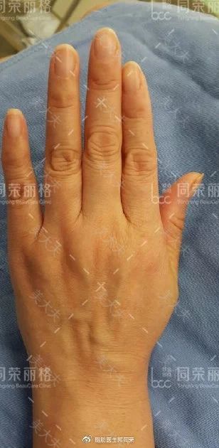 很少有人知道的脂肪用途（三）丰手篇