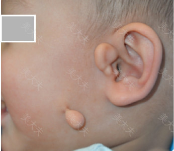 “小耳朵”的烦恼