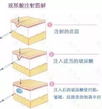 玻尿酸最强科普，你最关心的都在这，一次给你扯清楚