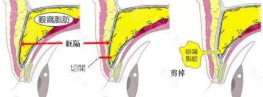 双眼皮