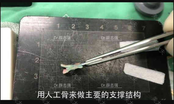 4 0鼻综合丨舒铂 人工骨 为什么可以替代肋软骨 二 其他 美大夫 4 0鼻综合丨舒铂 人工骨 为什么可以替代肋软骨 二 其他 美大夫