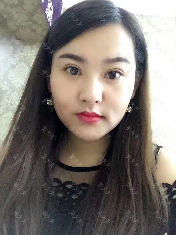 双眼皮术后攻略