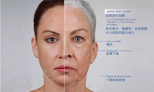（图一）皮肤比同龄人衰老的表现