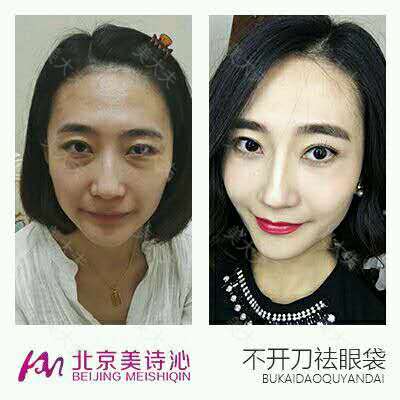 眼袋卧蚕同时出现 美与丑只在一念之间 激光去眼袋 内切去眼袋 眶隔脂肪释放 韩雪 美大夫 眼袋卧蚕同时出现 美与丑只在一念之间 激光去眼袋 内切去眼袋 眶隔脂肪释放 韩雪 美大夫