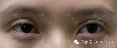 课堂案例丨修复案例8号：阳光总在风雨后——多次修复术后10个月随访