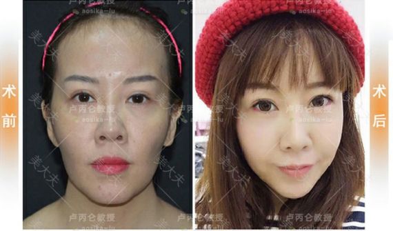 脂肪填充案例.png