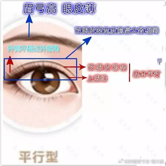 平行双眼皮