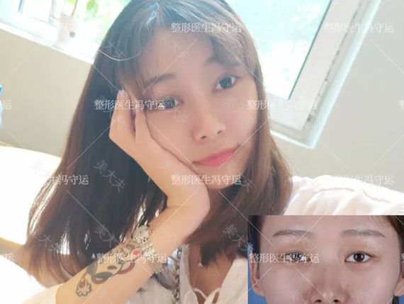 秋月 上睑下垂.jpg