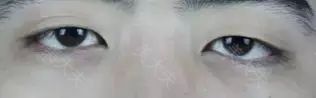 你以为你的眼睛不好看只是因为单眼皮？