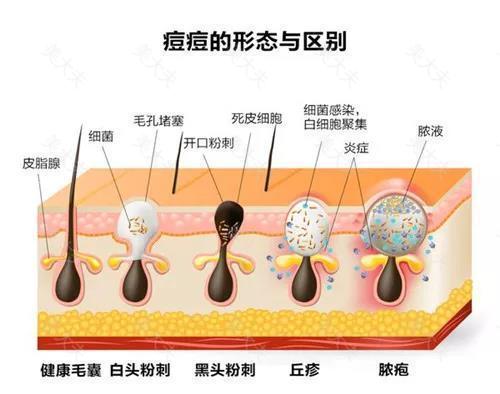 用这两招改善10年黑头，从此黑头不爱长