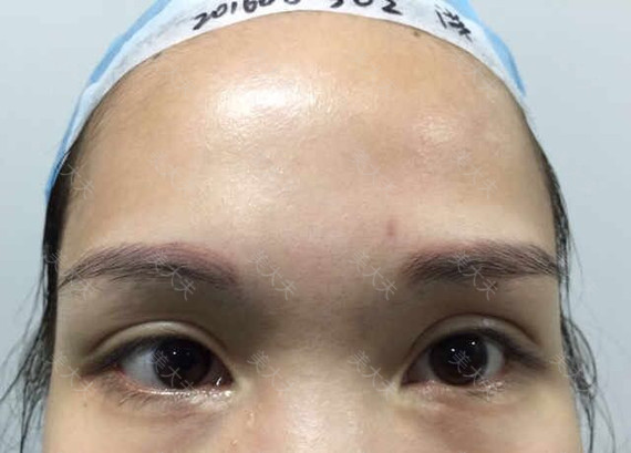 双眼皮修复案例：怀疑潘贰修复切肌肉，去组织的可以看看这个案例