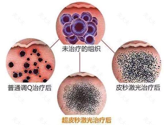 治疗太田痣是超皮秒好，还是调Q激光？